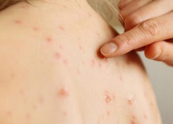 OMS y UNICEF alertan sobre gran aumento de sarampión en Europa